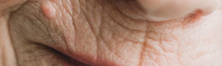 Glicación y envejecimiento: cómo el azúcar acelera las arrugas