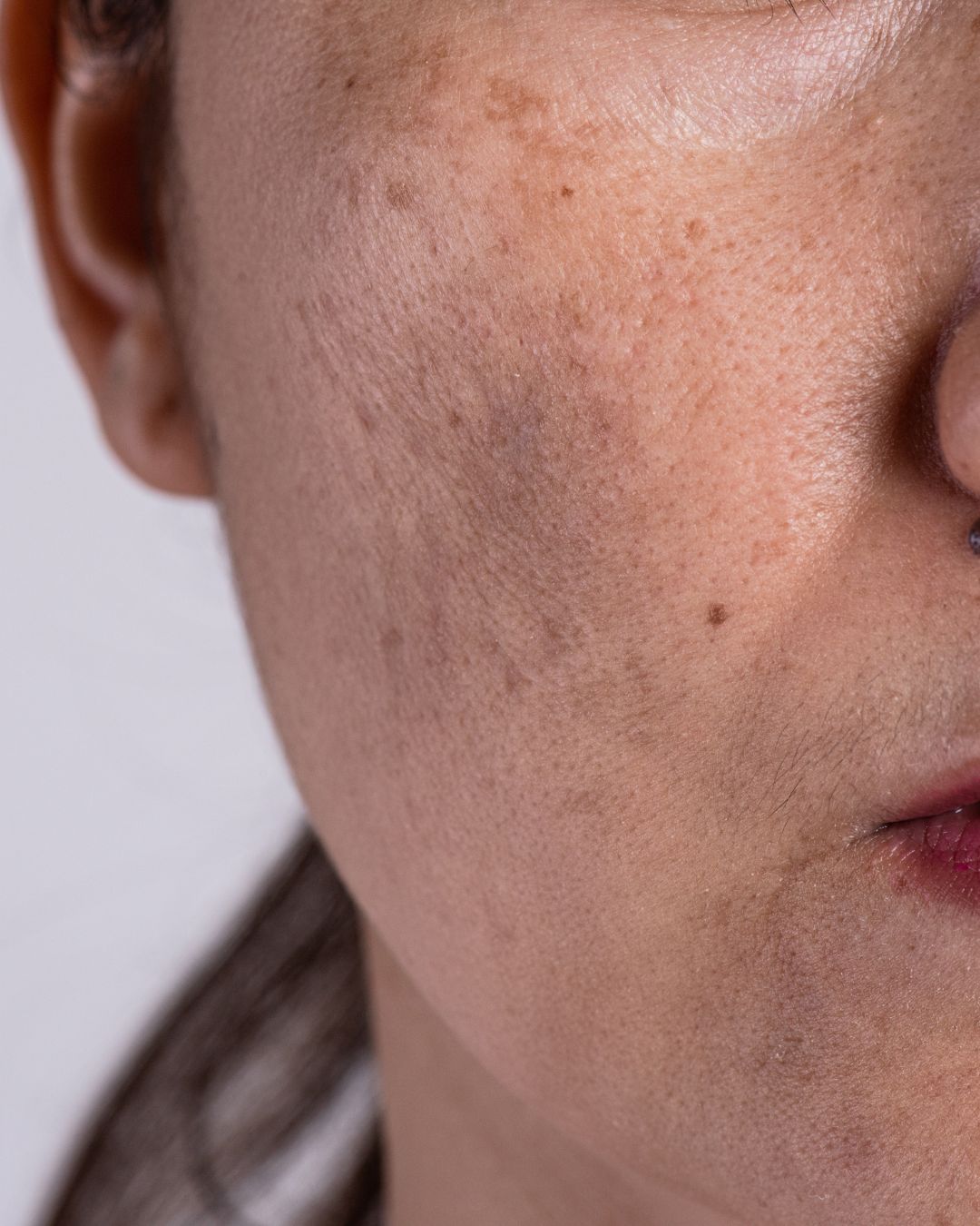 ¿Cómo tratar las manchas en la piel?